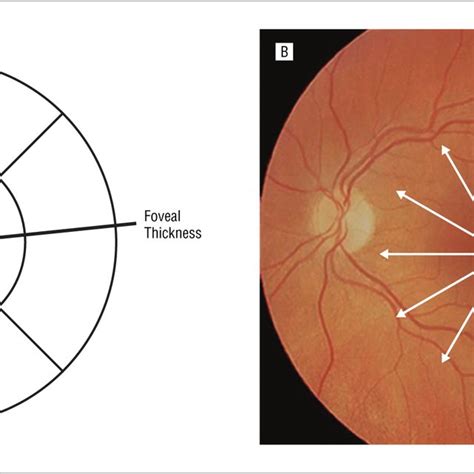 what is normal foveal thickness